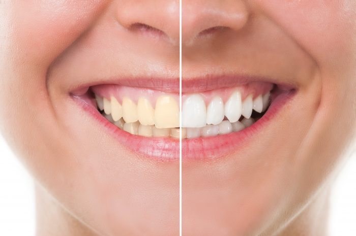 teeth whitening san dimas