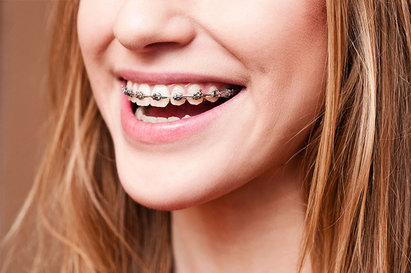 Orthodontics - Sierra Dental Care, San Dimas Dentist