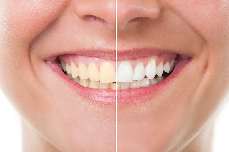 Teeth Whitening - Sierra Dental Care, San Dimas Dentist